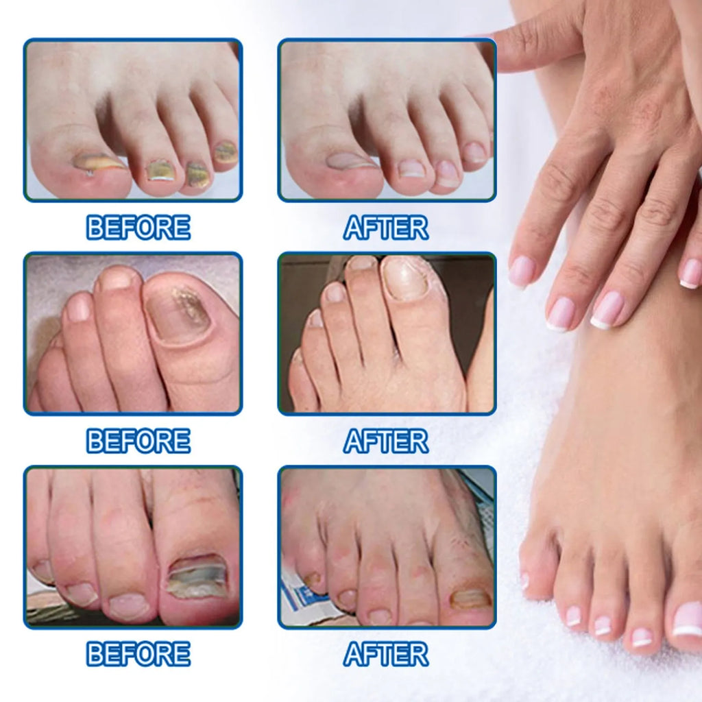 Nail repair adhesive bandages set with 32 patches measuring 6.1 x 3.5 cm for nail nursing