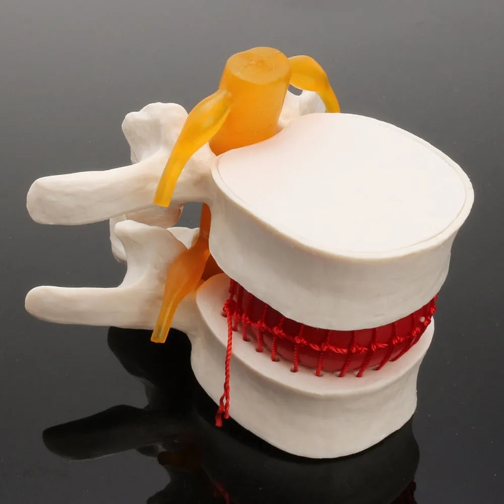 White PVC medical model showing lumbar intervertebral disc herniation anatomy for educational use