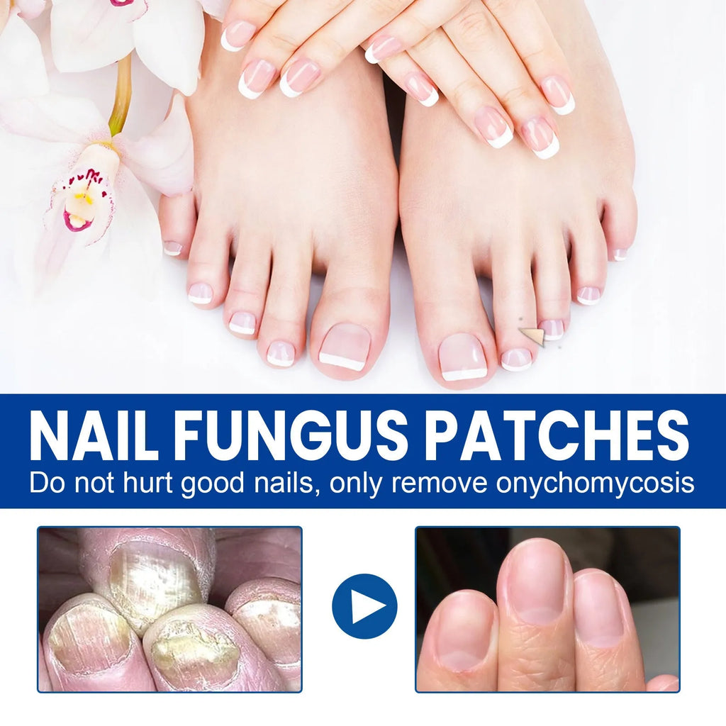 Nail repair adhesive bandages set with 32 patches measuring 6.1 x 3.5 cm for nail nursing