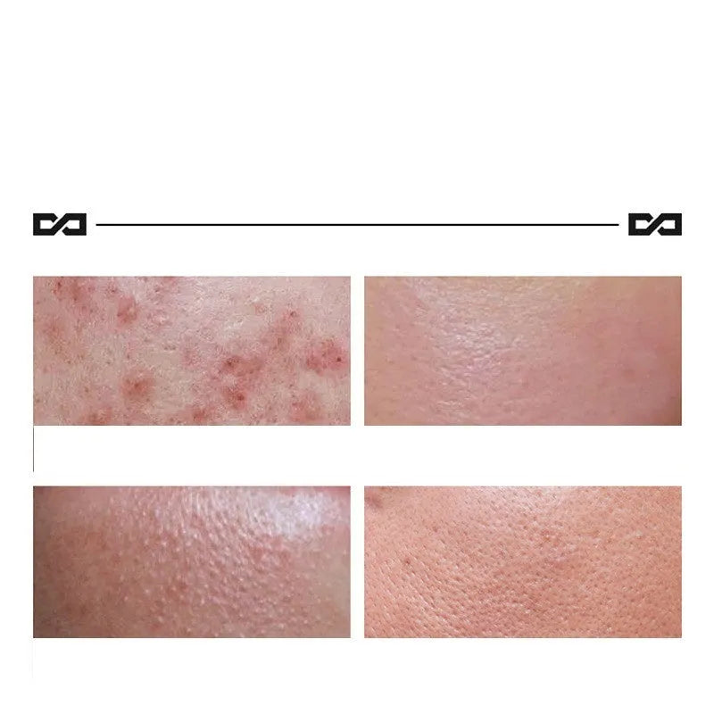 Herbal lightening acne cream 100g tub with niacinamide salicylic acid