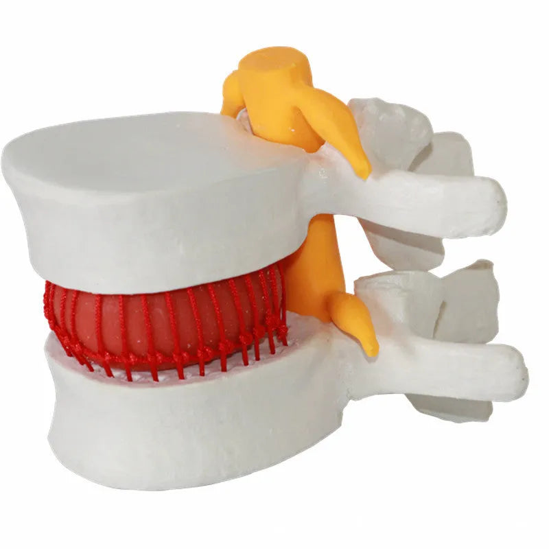 White PVC medical model showing lumbar intervertebral disc herniation anatomy for educational use