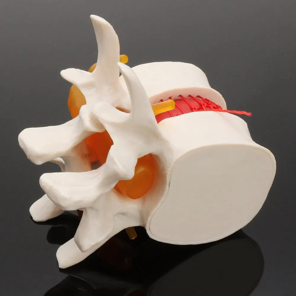 White PVC medical model showing lumbar intervertebral disc herniation anatomy for educational use