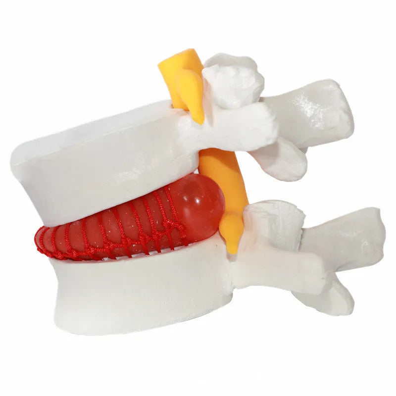 White PVC medical model showing lumbar intervertebral disc herniation anatomy for educational use