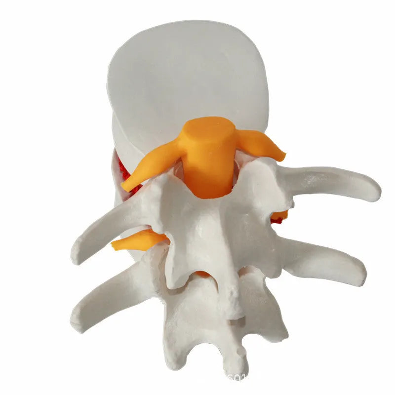 White PVC medical model showing lumbar intervertebral disc herniation anatomy for educational use