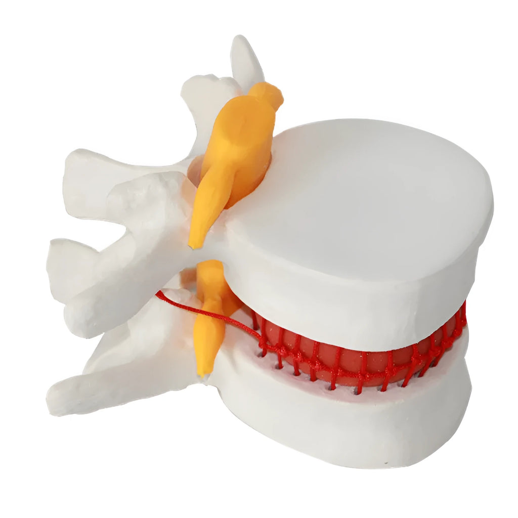 White PVC medical model showing lumbar intervertebral disc herniation anatomy for educational use