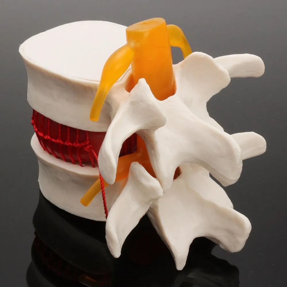 White PVC medical model showing lumbar intervertebral disc herniation anatomy for educational use