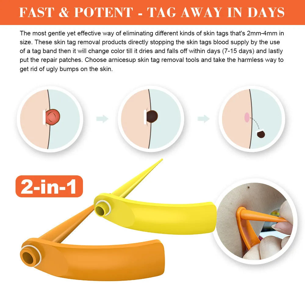 Orange-yellow mole removal tool kit with two devices, rubber rings, alcohol swabs and repair stickers