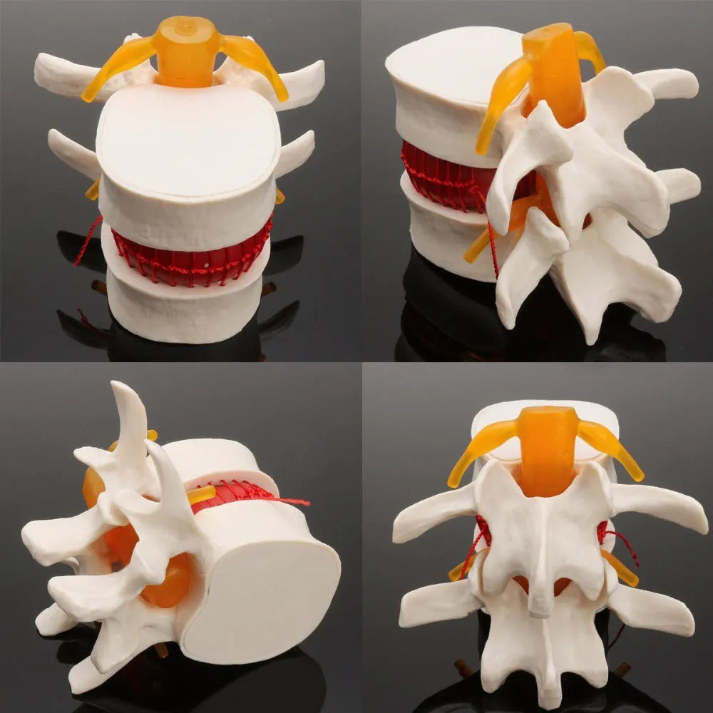 White PVC medical model showing lumbar intervertebral disc herniation anatomy for educational use