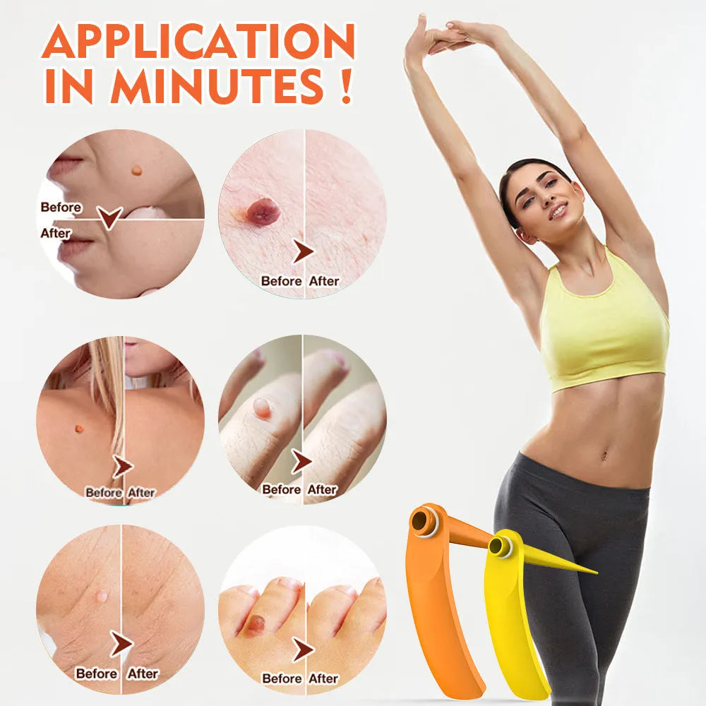 Orange-yellow mole removal tool kit with two devices, rubber rings, alcohol swabs and repair stickers