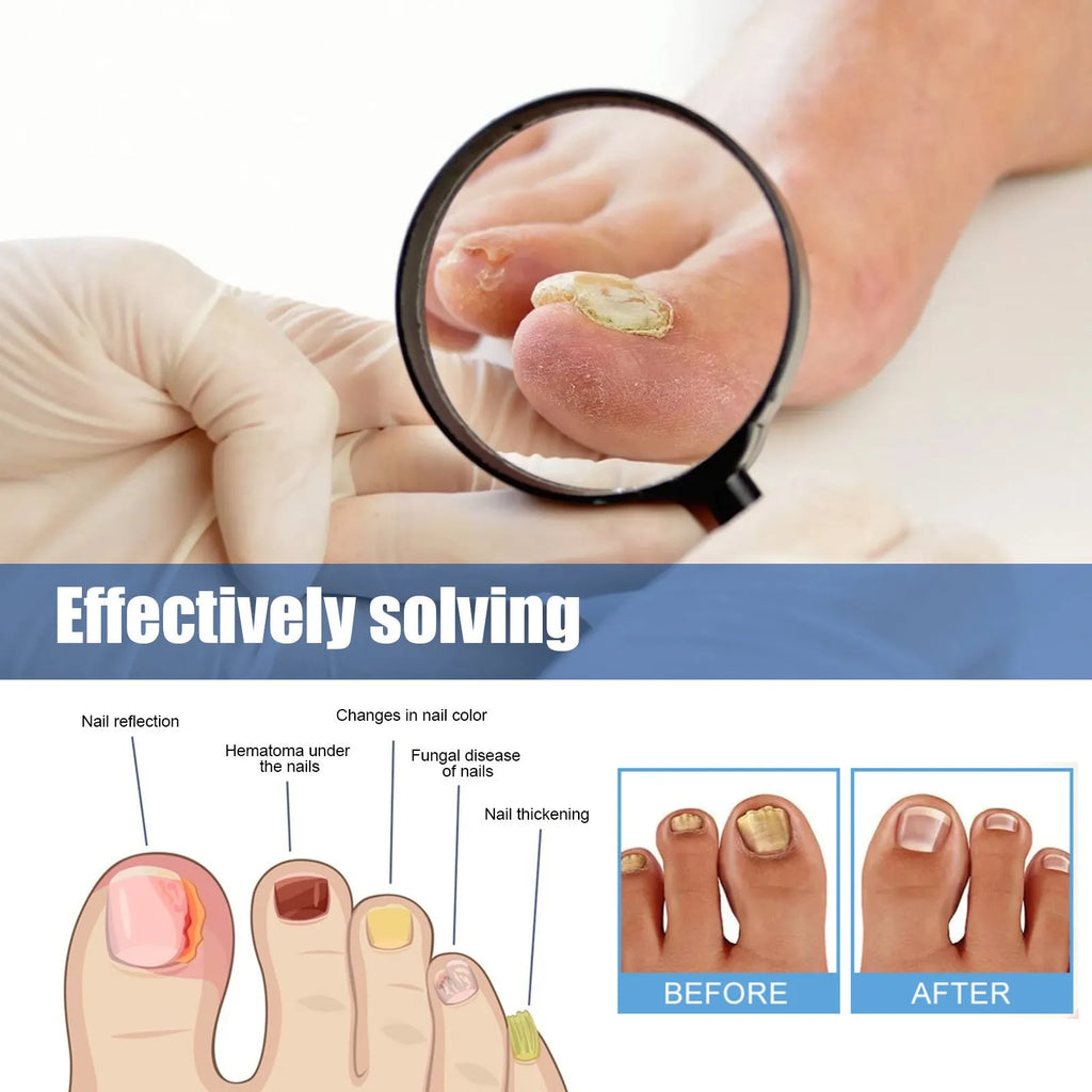 Nail repair adhesive bandages set with 32 patches measuring 6.1 x 3.5 cm for nail nursing