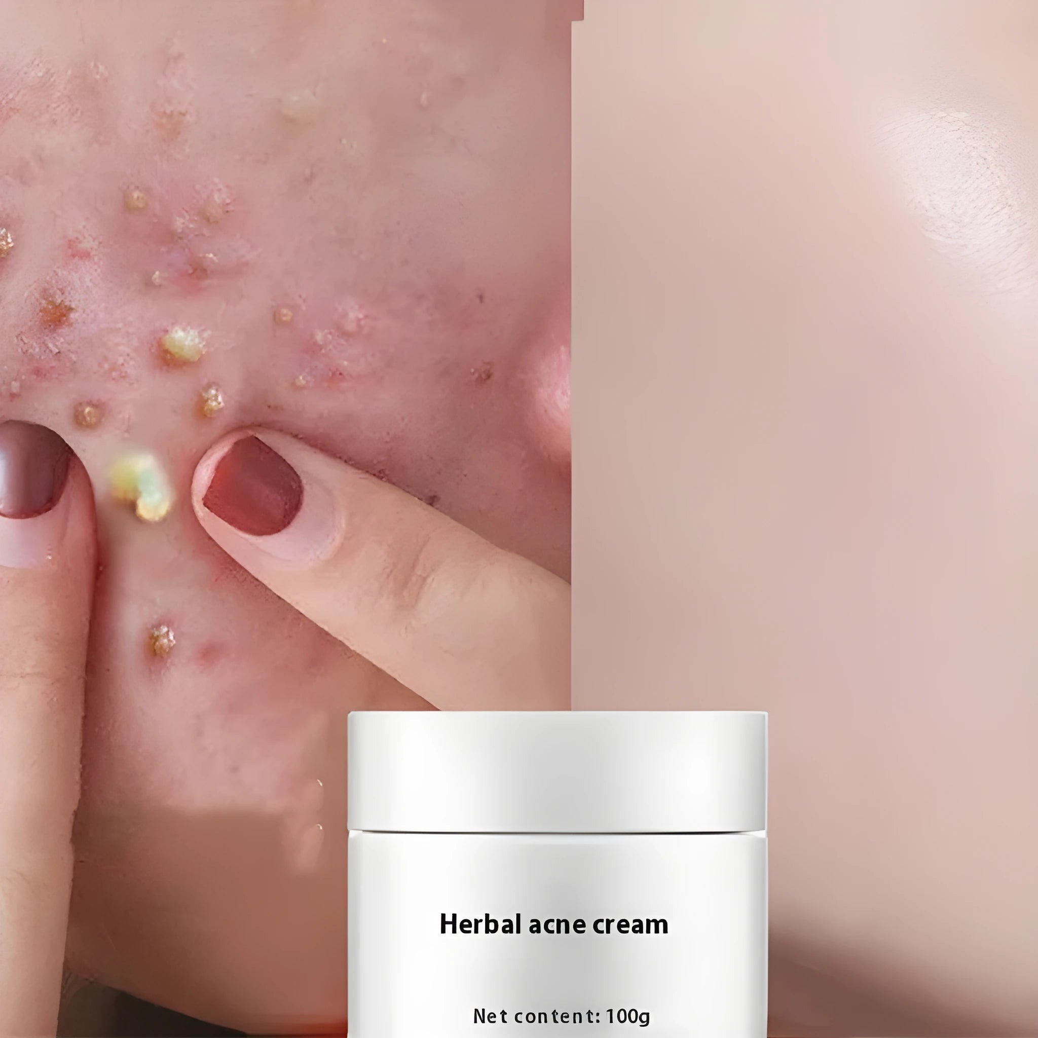 Herbal lightening acne cream 100g tub with niacinamide salicylic acid