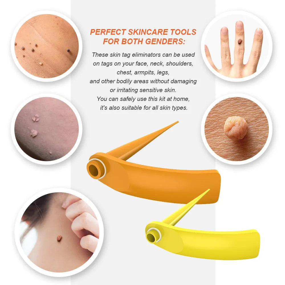 Orange-yellow mole removal tool kit with two devices, rubber rings, alcohol swabs and repair stickers